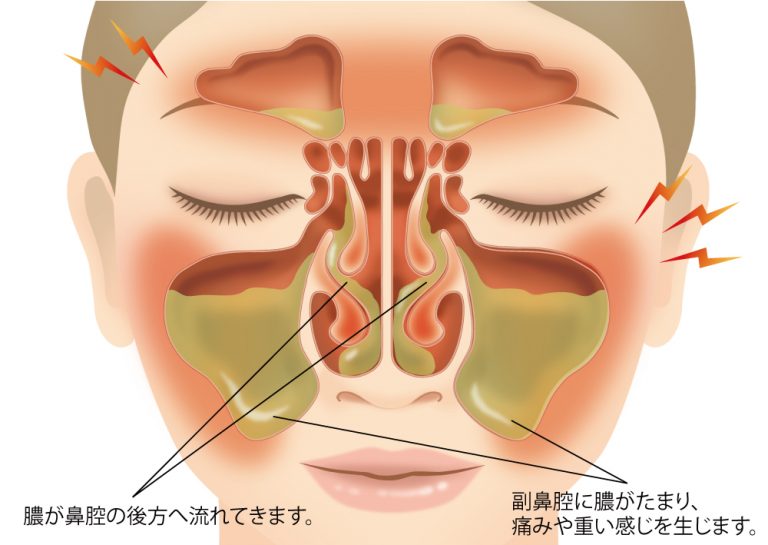 鼻水 目 の 腫れ