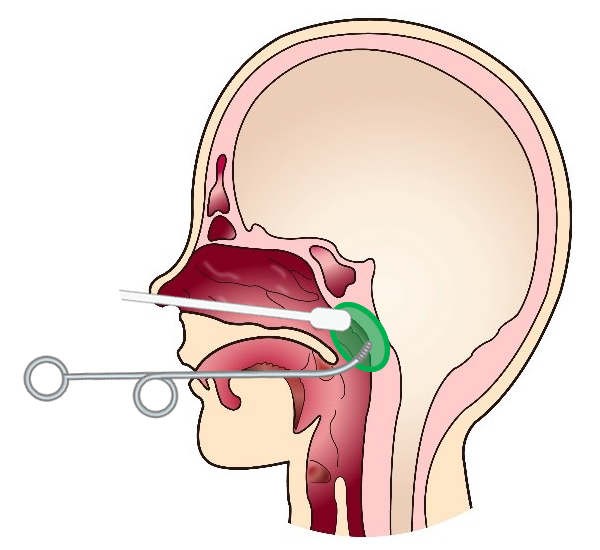 Bスポット療法 神谷耳鼻咽喉科クリニック
